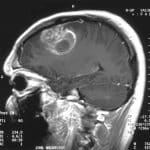 Glioblastoma Lawsuit Attorneys brain scan