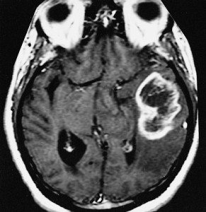 GLIOBLASTOMA MULTIFORME As seen here by magnetic resonance imaging, the glioblastoma multiforme usually exhibits a 