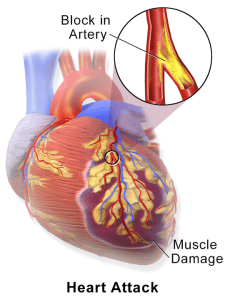 Heart Attack Medical Definition