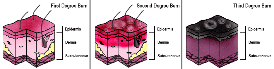 Burn Injury Lawyer - First, second and third degree burn diagrams